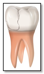 Fractured cusp tooth